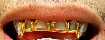 Custom Made 14k Gold Overlay Removable Grillz Teeth /Gold Plate Caps/ 6 Teeth Top or Bottom Fangs/6